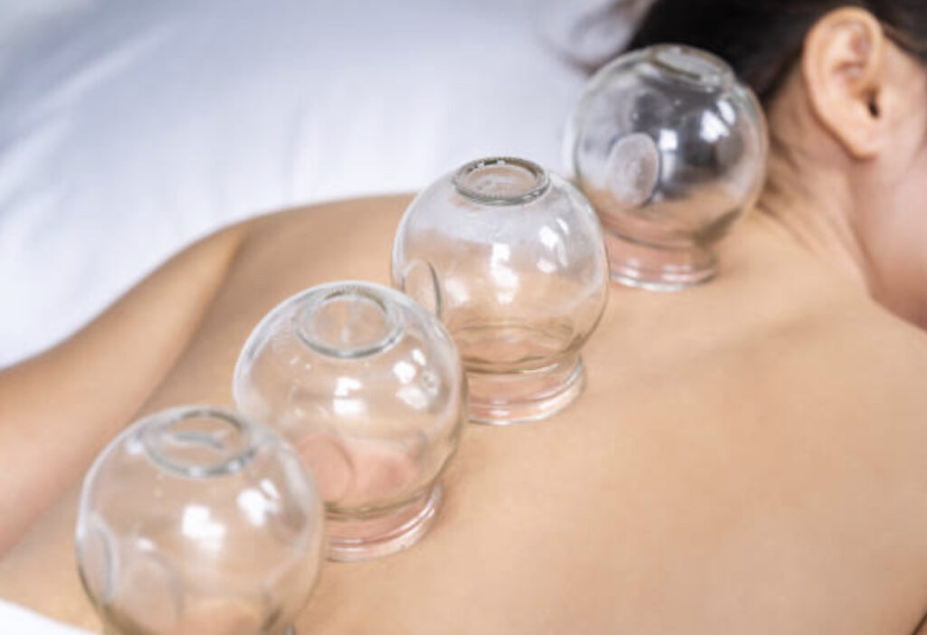 Cupping